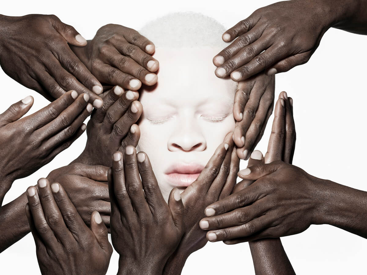 serie fotografica albus cara albino con manos negras justin dingwall